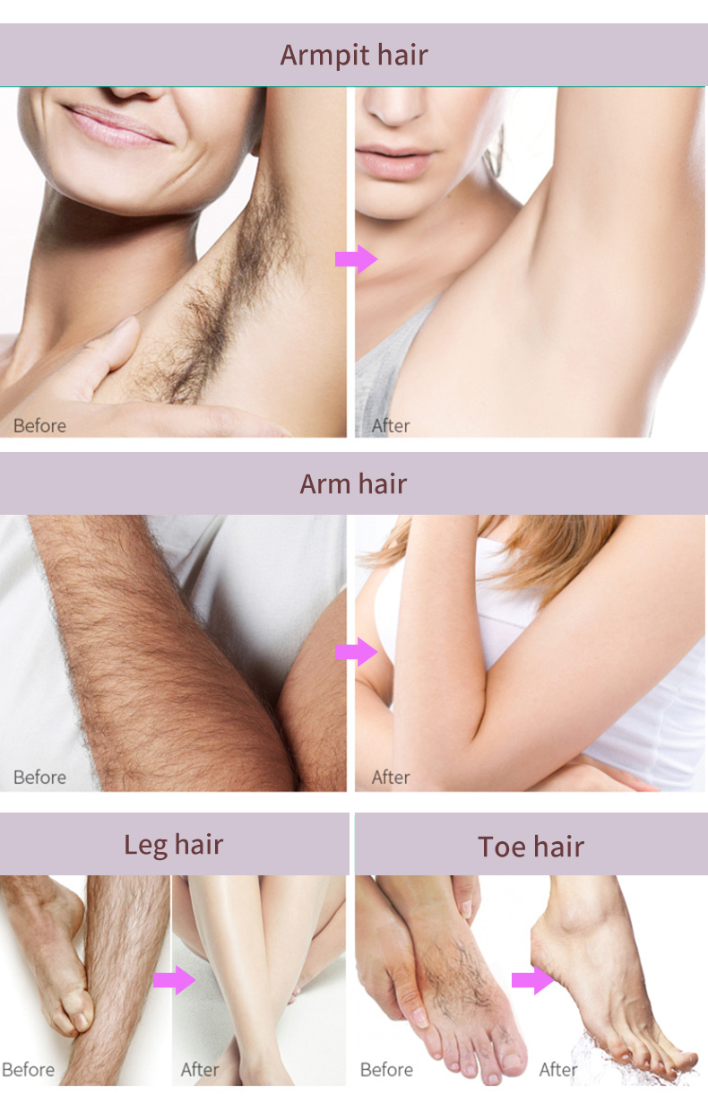 Li Malê Bikar bînin Body Hair Removal Cream Spray-5